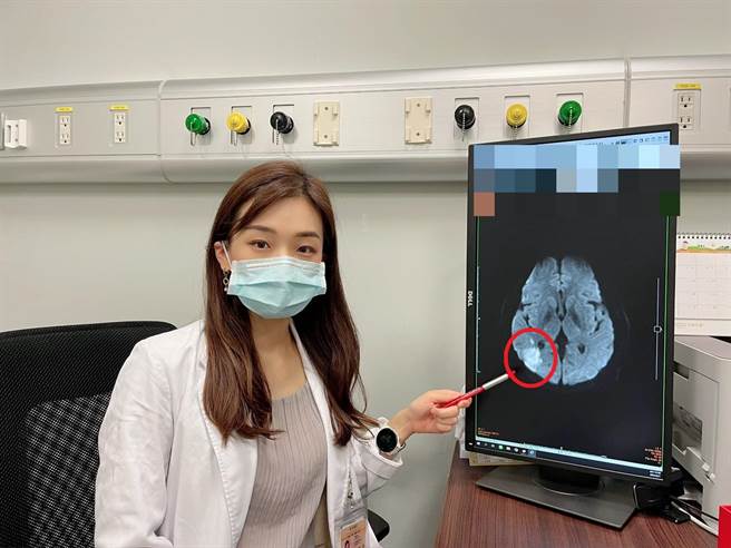 长安医院神经内科医师陈惠萱表示，静脉雷射是一种低能量雷射且温和安全，可帮助脑中风患者的神经修復。(红圈为病患脑血管梗塞处)（长安医院提供／冯惠宜台中传真）