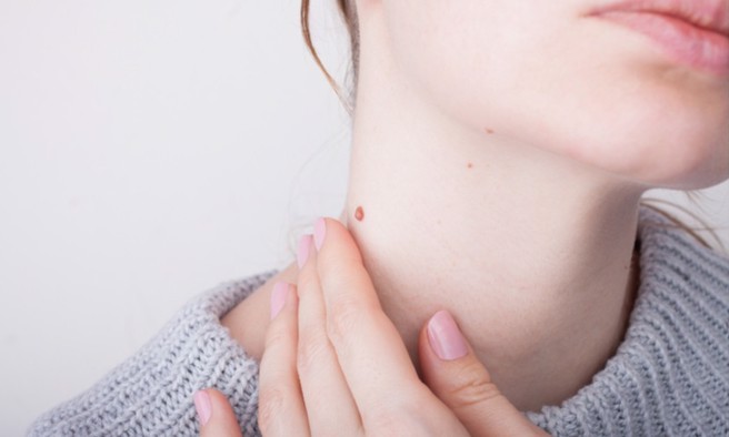 自行除痣未改運先傷皮膚 3種除痣方法一次看。(示意圖/Shutterstock)