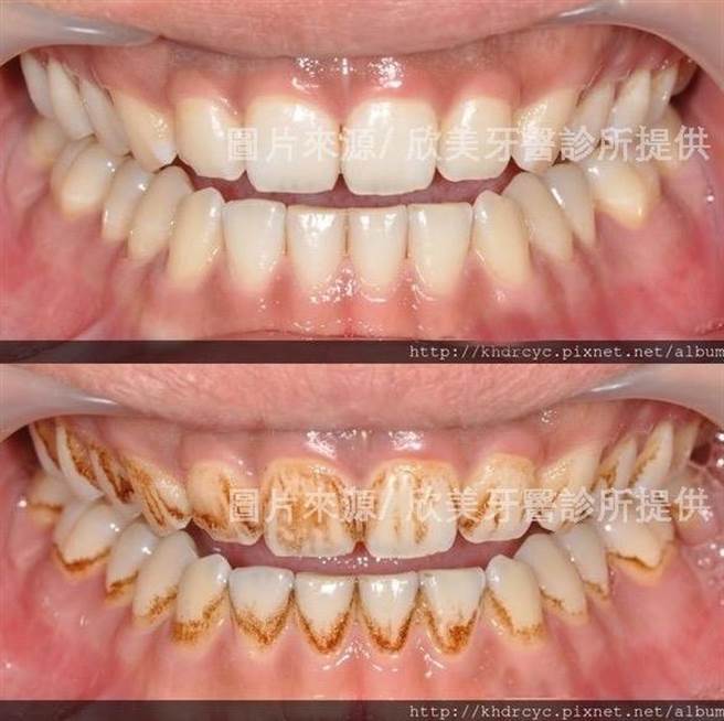 男大生担心牙齿累积陈年烟垢影响求职，藉由喷砂美白大幅改善。（柯宗纬翻摄）
