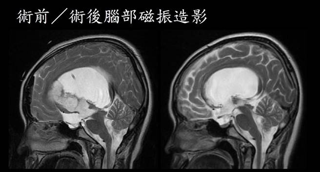 正常人腦的腦室是纖細的，13歲女孩的腦室被7公分大腫瘤撐開壓迫（圖左），右圖為手術後。（臺大雲林分院提供）