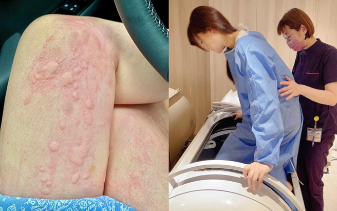 陈海茵荨麻疹发作时会痒到呼吸困难，需要求助于专业医学团队治疗。（图／取自陈海茵IG）