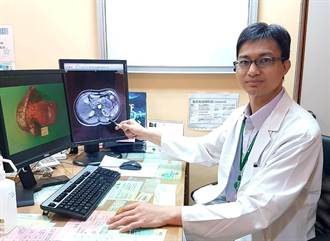 8.4公分胰臟腫瘤 3D腹腔鏡成功摘除