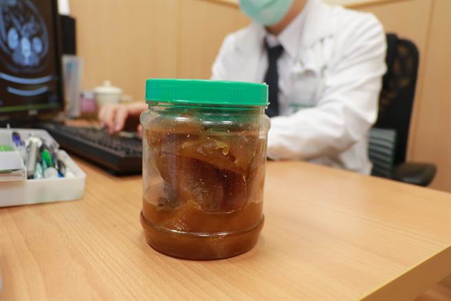 88岁妇人罹患胃癌，疑偏爱好下饭腌渍食品有关。（台中慈济医院提供）