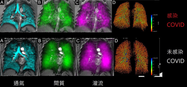 新冠肺炎感染者与健康者的肺部影像。（图／翻摄自苏一峰脸书粉专）