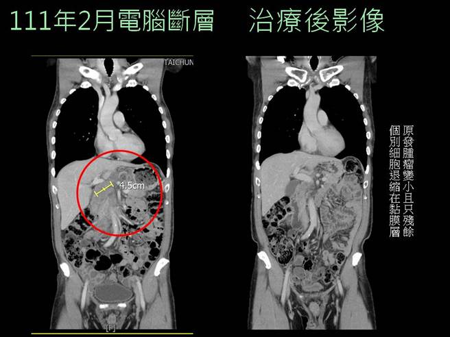 男子胃癌治療前後差異。(台中慈濟醫院提供)