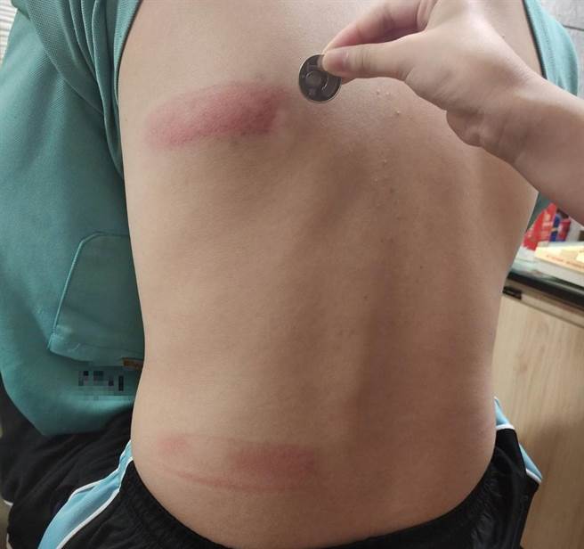 学生遭蔡姓男导师殴打的部位。（人本教育基金会提供／袁庭尧高雄传真）