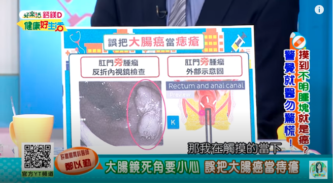 女患者的肿瘤刚好位在大肠镜死角，才因此一直没有检查出结果。（图／翻摄自YouTube／年代MUCH台 健康好生活）
