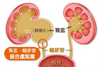 先天腎盂輸尿管接合處狹窄 摘腎擺脫長年腎水腫