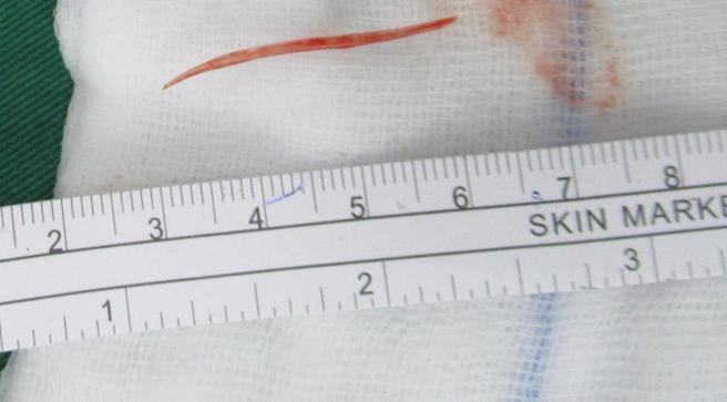 48岁王姓男子因腹痛前往部立彰化医院挂急诊，医师发现，王男腹内有3公分长鱼刺穿出胃部，穿孔处虽已癒合，脓疡却压迫胆囊及胆道系统，造成胆囊发炎。（图/ 中央社）
