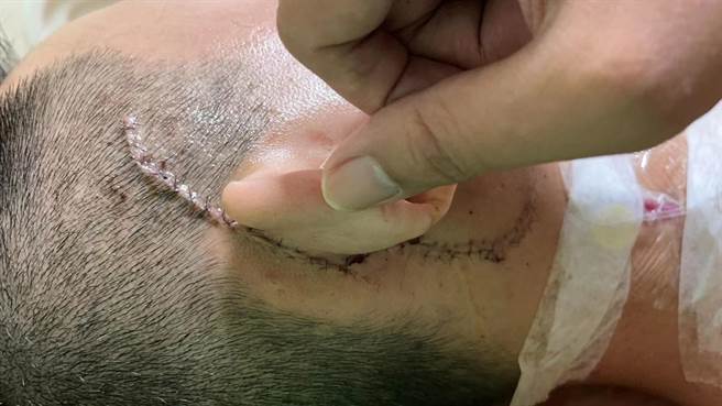 连邱右边的耳朵都差点被削掉，造成邱全身四肢多处撕裂伤，颈部旁还有刀伤。（民眾提供／吴佩蓉宜兰传真）