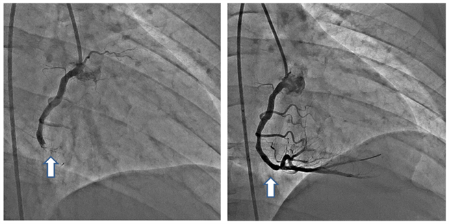 患者经心导管发现（左图）右冠状动脉因血栓形成，导致完全堵塞，引发心肌梗塞。（右图）经置放心血管支架，右冠状动脉重获血液循环。（澄清医院提供／冯惠宜台中传真）