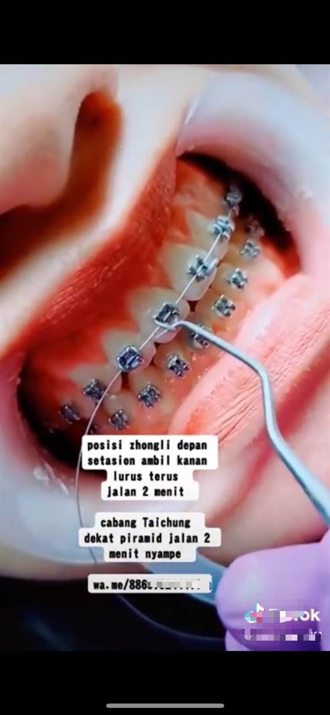 勤隊今年初接獲民眾檢舉，指稱有印尼籍女性失聯移工透過臉書、抖音等社群媒體發布口腔牙齒矯正、牙齒美白、補牙及隆鼻等廣告。（桃園市專勤隊提供／陳夢茹桃園傳真）