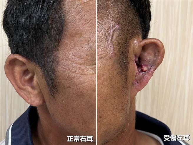 經手術治療後，張先生的左右耳對稱性明顯恢復許多。（亞大附醫提供／張亦惠台中傳真）