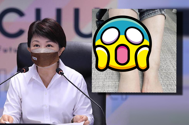 台中市长卢秀燕在脸书分享右脚肿胀情况，宣布将请假2天，但强调市政运作不会停摆。(左/中时资料照、右/摘自卢秀燕脸书)