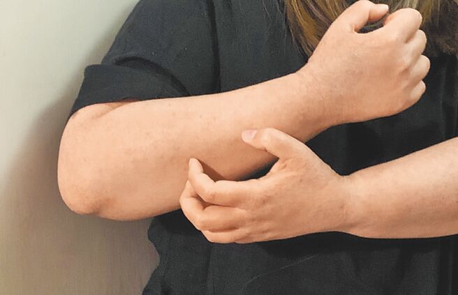 异位性皮肤炎病友饱受皮肤搔痒之苦，病灶遍布全身几乎「体无完肤」。（病友陈小姐提供）