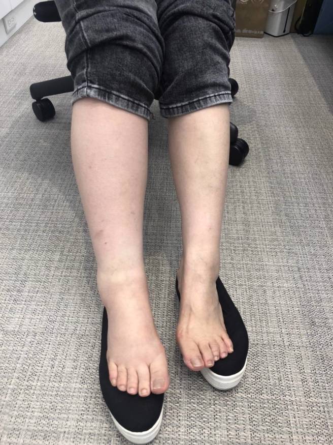 市长卢秀燕腿部的问题，由照片中发现已呈一大一小状态，今日再度赴医院检查与治疗。（台中市政府提供）