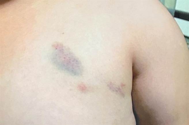 男童左胸遭翁师掐捏造成瘀挫伤，学童家长愤而提告伤害，二审改判拘役50天。(家长提供／曹婷婷台南传真)