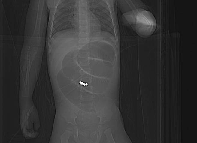 王姓幼儿小肠有多颗圆形异物，造成肠阻塞。（童综合提供／陈淑娥台中传真）