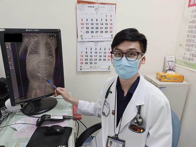 童综合医院一般外科医师张孟浩笔指处即为巴克球在小肠位置。（陈淑娥摄）