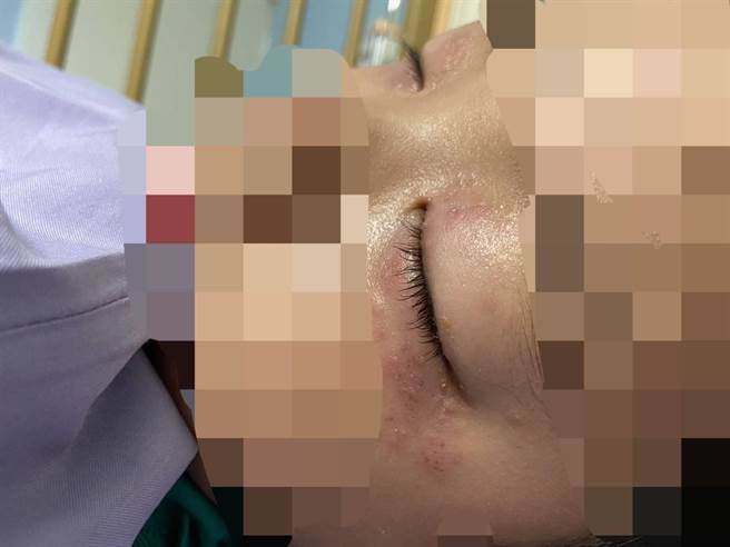 男童确诊后为轻症，但却感染带状泡疹，眼睛黑一圈。（童综合提供／陈淑娥台中传真）