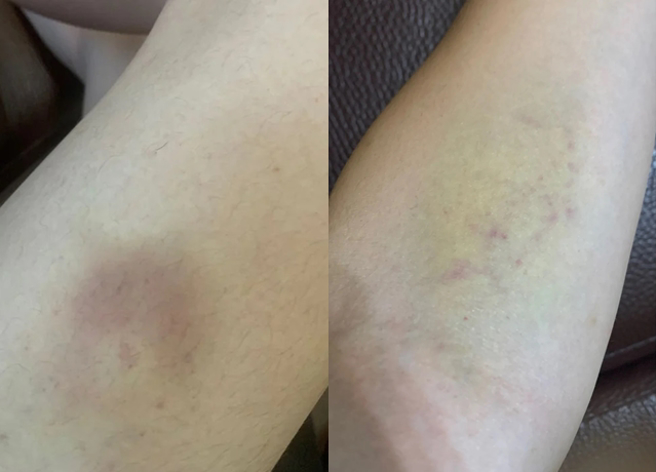 人妻因為每次和老公嘿咻後，自己常「遍體麟傷」，導致她萌生離婚念頭。（翻攝自Dcard）