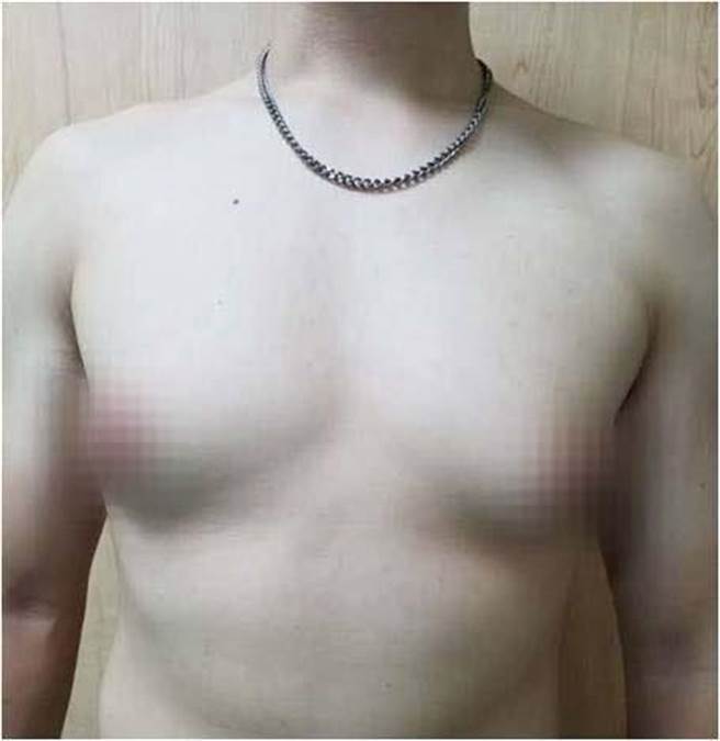 陈男罹患男性女乳症，即使减重胸前依旧相当明显。（光田医院提供）