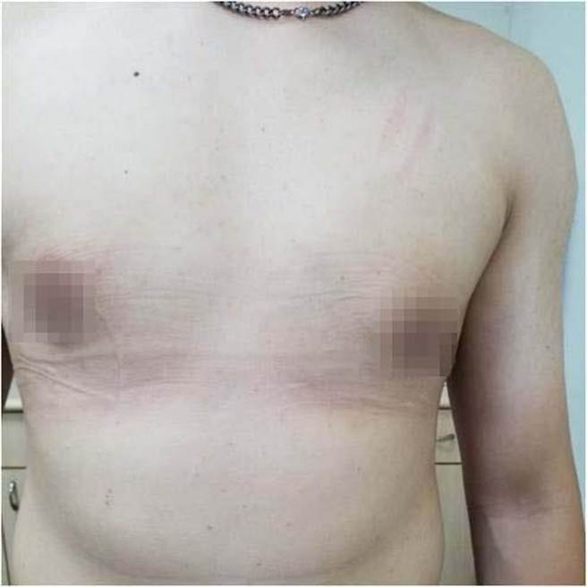 陈男术后半年胸部明显缩小。（光田医院提供）