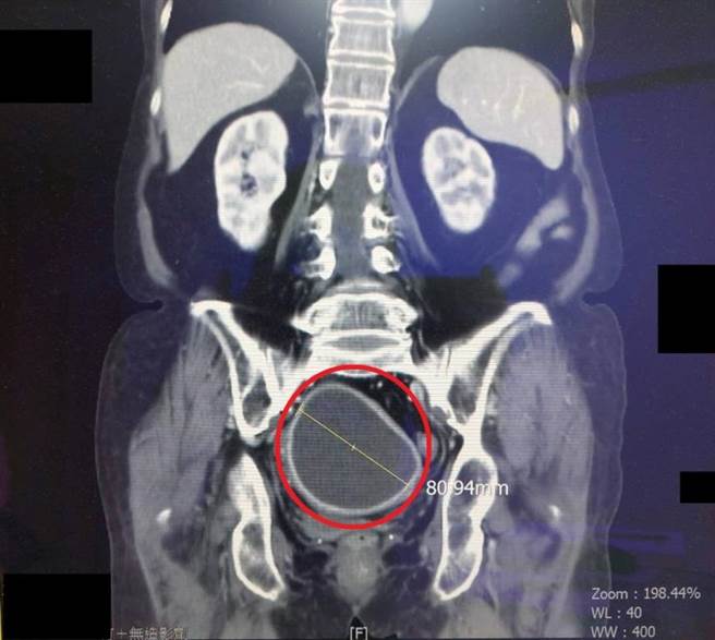 经电脑断层检查，李奶奶腹部有疑似8公分大的肿瘤(红圈处)，进一步子宫镜检查发现为子。（大千医院提供／李京升苗栗传真）