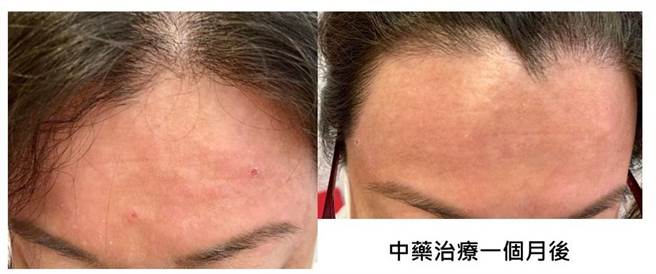 林小姐就医时面部红肿且红疹布满两颊及额头。（仁爱医院提供／冯惠宜台中传真）