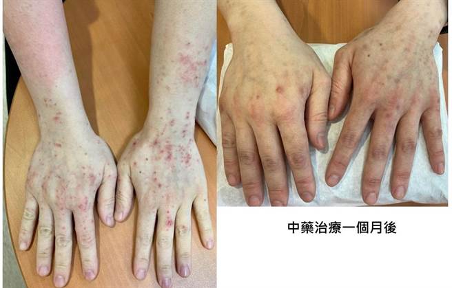 林小姐到大里仁爱医院中医就诊时，上臂出现明显的红色丘疹分布上臂延伸至手背。 （仁爱医院提供／冯惠宜台中传真）