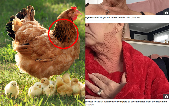 鲍曼结束疗程后发现脖子上留下数百个黑色斑点，气喊自己活像只「老母鸡」。（图／翻摄自《太阳报》、达志影像）