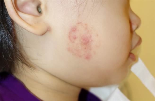 1岁半女娃被虫叮咬，妈妈上网团购买止痒贴让女娃使用，反而引发她的皮肤过敏，脸颊出现比10元硬币还大的圆形红疹区块。（茂盛医院提供／冯惠宜台中传真）