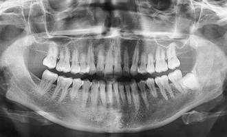 「大白鯊男孩」嘴裡塞滿526顆牙 醫檢查一看秒嚇傻