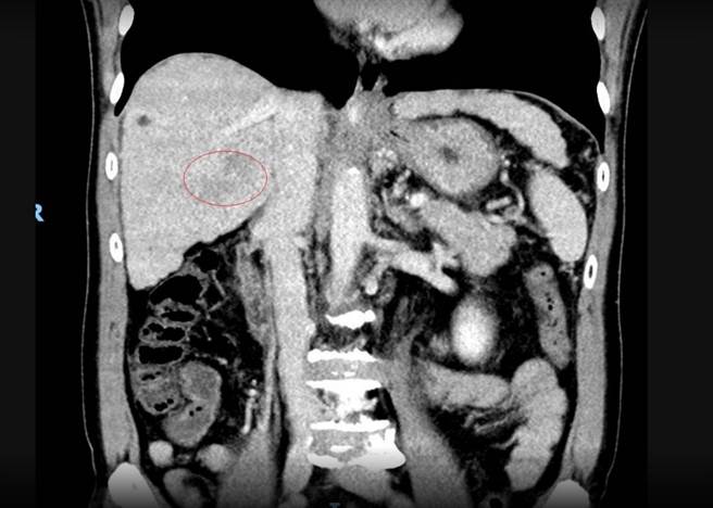53岁的詹姓男子轻忽B肝，10多年未追踪竟已是晚期肝癌，肿瘤10公分。（彰化医院提供／吴敏菁彰化传真）