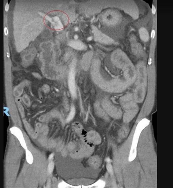 53岁的詹姓男子轻忽B肝，10多年未追踪竟已是晚期肝癌，肿瘤10公分，经治疗后，肿瘤几乎都消失了。（彰化医院提供／吴敏菁彰化传真）