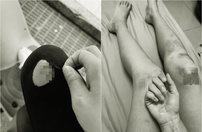 杨净宇曝光溅血伤势照，表示虽然只是擦伤，但回家上药还是痛到哭出来。(取材自杨净宇脸书)