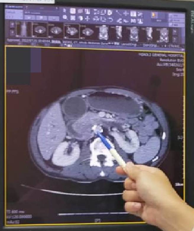 医师高浩伟指出，透过电脑断层检查，发现患者十二指肠与胰臟头交界处，有一个约4公分大的肿瘤。（部立苗栗医院提供／谢明俊苗栗传真）