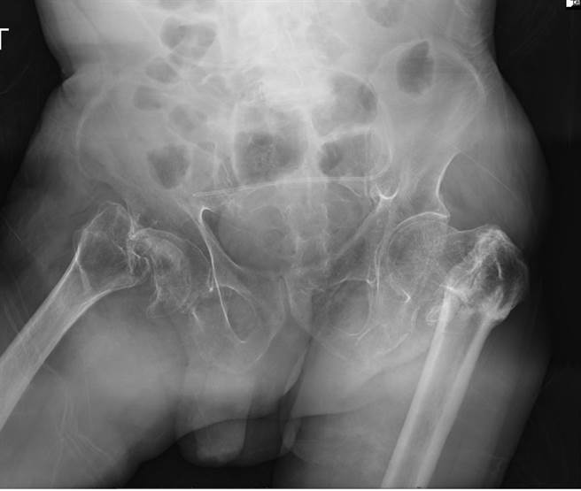 78岁沈先生被送到急诊，经X光检查已是双侧髋部骨折变形合併关节炎。（大里仁爱医院提供／冯惠宜台中传真）