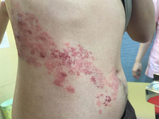 30岁年轻人2两3度罹患带状疱疹，腰部大面积水泡，让人看了怵目惊心。（施胜桓提供／冯惠宜台中传真）