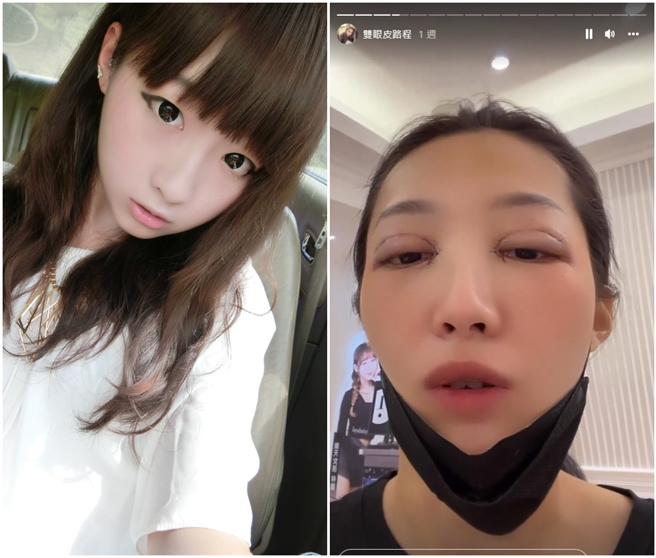 左图：欧菈8年前的少女样。右图：欧菈整形后的长相，目前还在恢復期。（图／FB@欧菈）