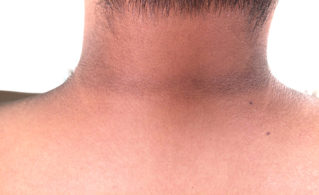 糖尿定患者狂吃消暑神物，結果脖子發黑、血糖飆破400mg/dl。（圖／shutterstock）