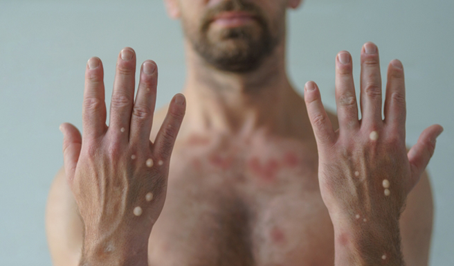 印尼已证实出现第一起猴痘感染病例。至于其他东南亚国家，菲律宾和泰国也都证实出现了病例。(示意图／shutterstock)