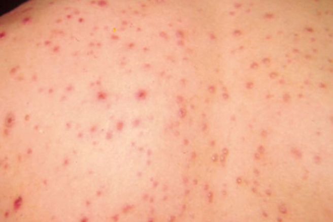  「蕃茄流感」会长出红色且疼痛的水泡而得名。(图/Twitter)