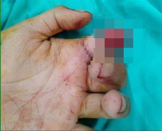 东势区15岁少年打工首日就发生意外，左手食指被截断送医，造成永久性职业伤害。（民眾提供）