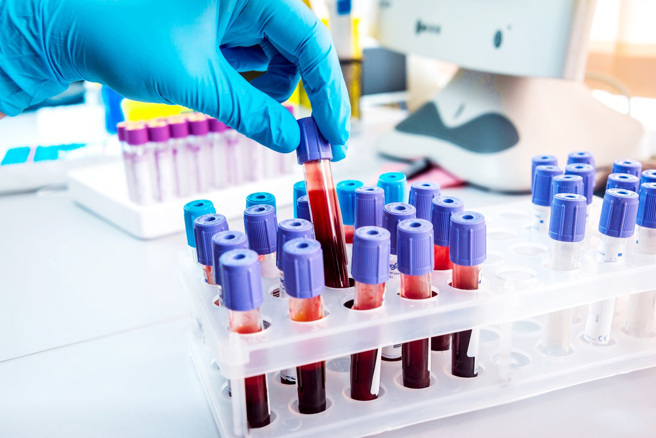 英國國民保健署（NHS）正與美國生物科技公司「Grail」進行大型癌症檢測實驗，透過驗血檢測超過50種癌症，預估每年能預防1／10的癌症死亡人數。（示意圖／shutterstock）