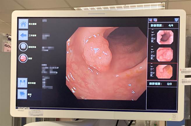 艺人余苑绮罹患直肠癌逝世，享年39岁，令人惋惜。花莲门诺医院除提醒民眾注意饮食及生活习惯，更要定期筛检及观察排便改变等，助于早发癌兆，早治疗。（花莲门诺医院提供／罗亦晽花莲传真）