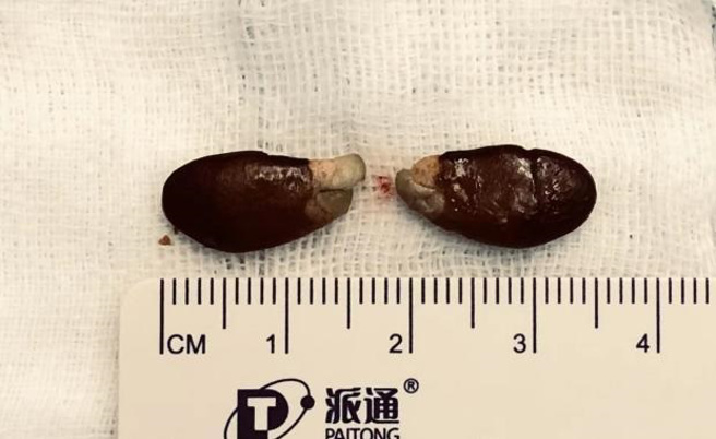 大陆一名男童误吞水果籽，没想到竟在他的气管处发芽。(图/翻摄自微博)