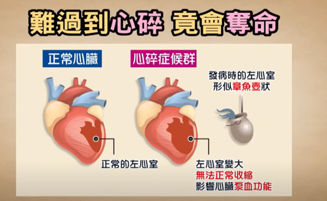 心碎症候群又称为章鱼壶心肌病变，是一位日本医师提出，因为病发时，心臟收缩形状像是传统捕章鱼使用的壶，因而得名。( 图/ 取自「健康2.0」)