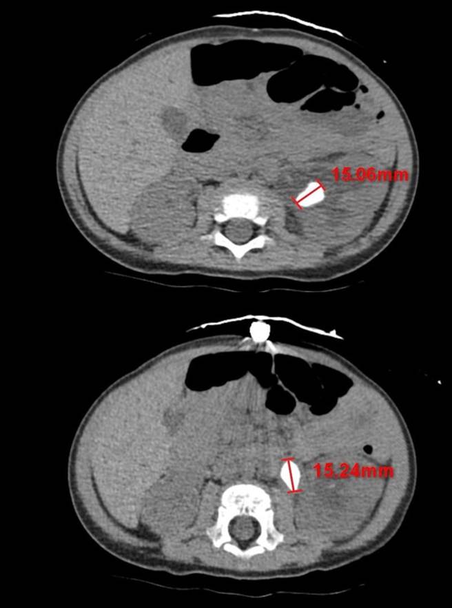 花蓮年僅11個月大余姓男嬰體內長出2顆約1.5公分的腎結石，造成急性腎臟發炎，經花蓮慈濟醫院醫護團隊使用全院最小尺寸的腎臟鏡，以「經皮腎鏡取石手術」順利將腎結石夾出後，已康復出院。（花蓮慈濟醫院提供／羅亦晽花蓮傳真）