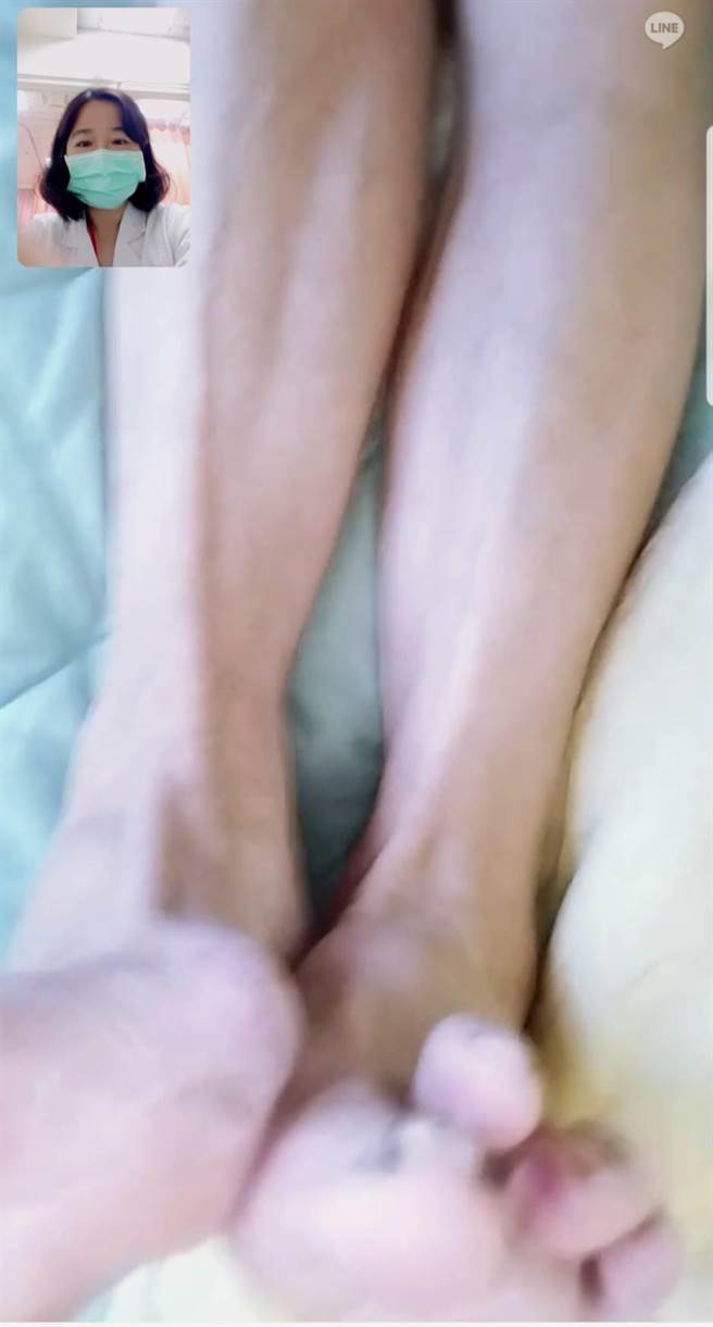 经过6日中药治疗，下肢水肿已退，可见到骨型。（丰原医院提供）